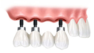 puente sobre implantes
