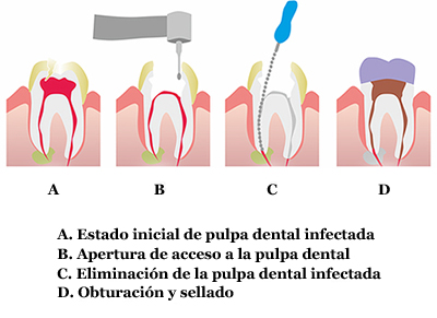 endodoncia_dibujo