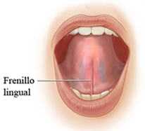 frenillo lingual_