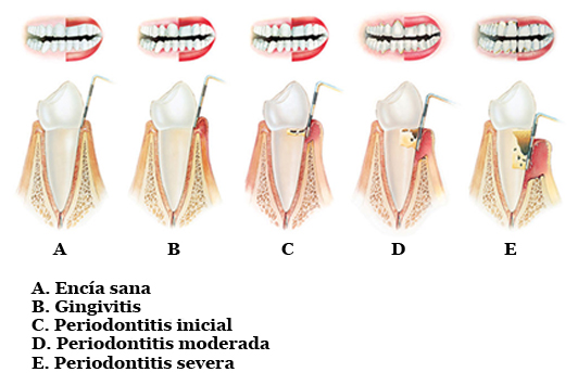 gingivitis_periodontitis_dibujo