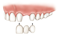 puente dental_